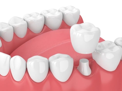 Dental crown preparation