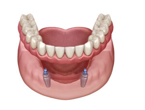 Implant snap in denture