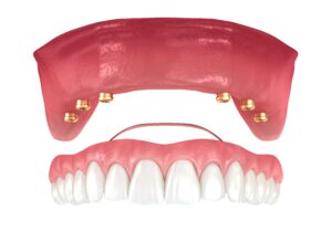 Snap in Denture implant