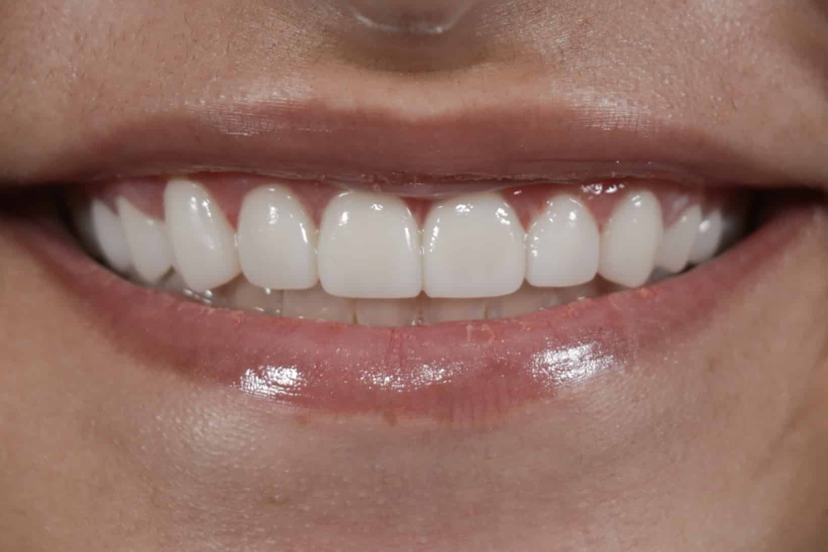 After Dental Crowns