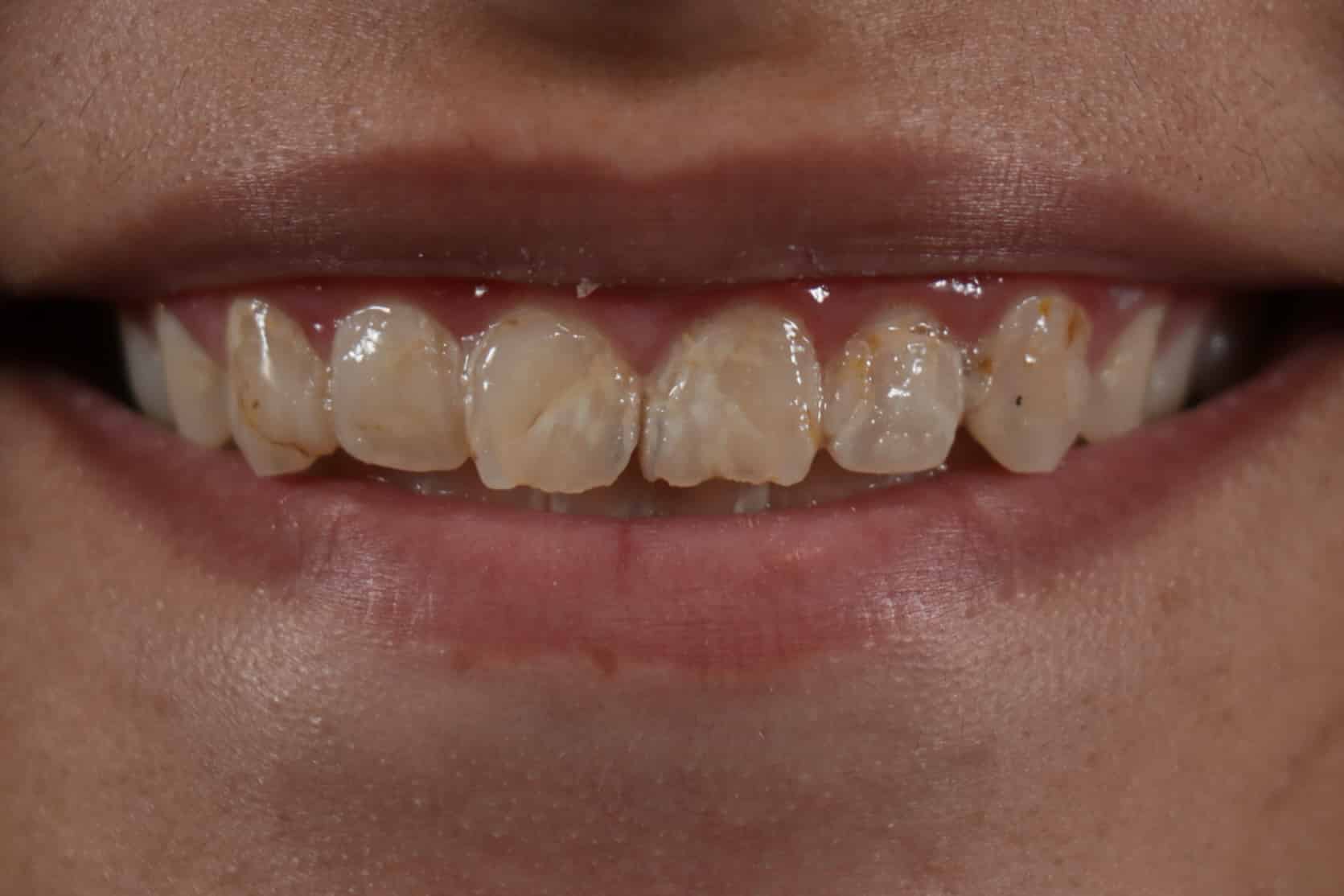 Before Dental Crowns