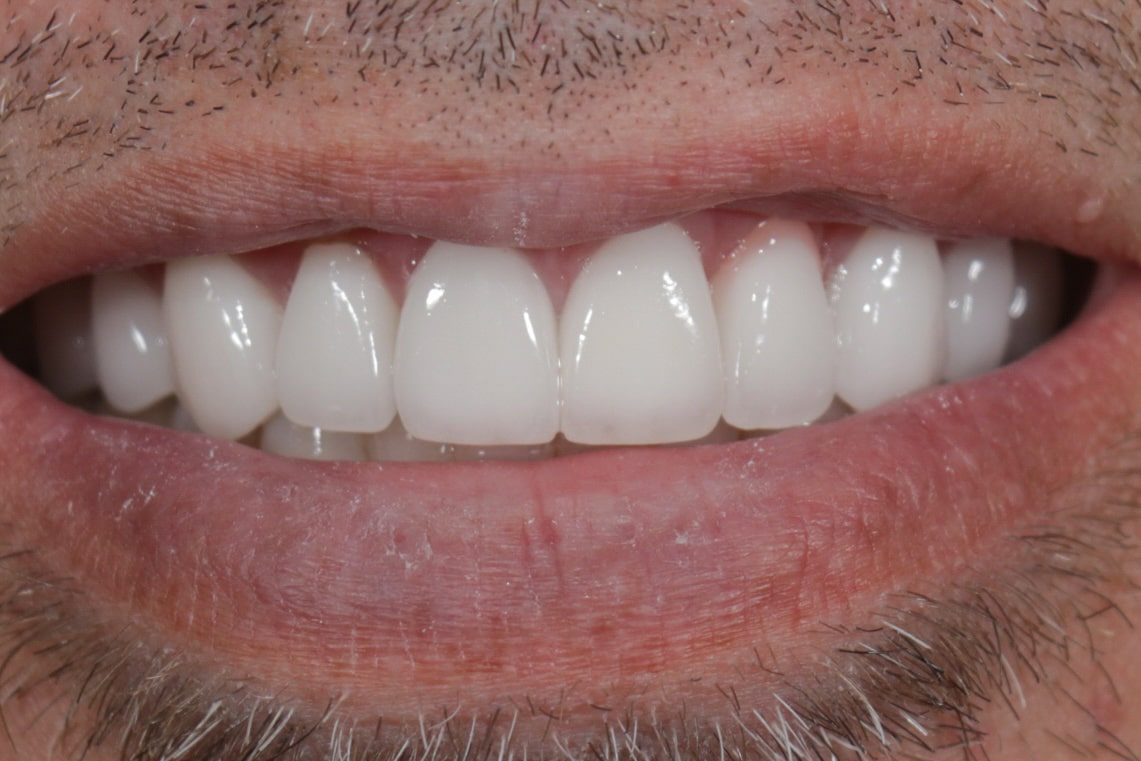 After Veneers